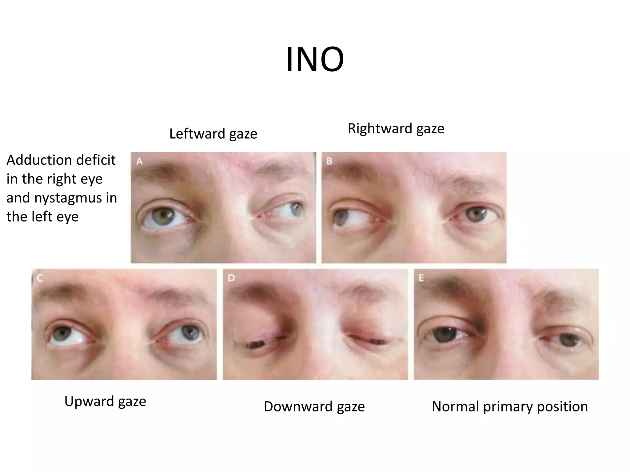 INO
Normal primary position
Leftward gaze Rightward gaze
Upward gaze Downward gaze
Adduction deficit
in the right eye
and nystagmus in
the left eye
 