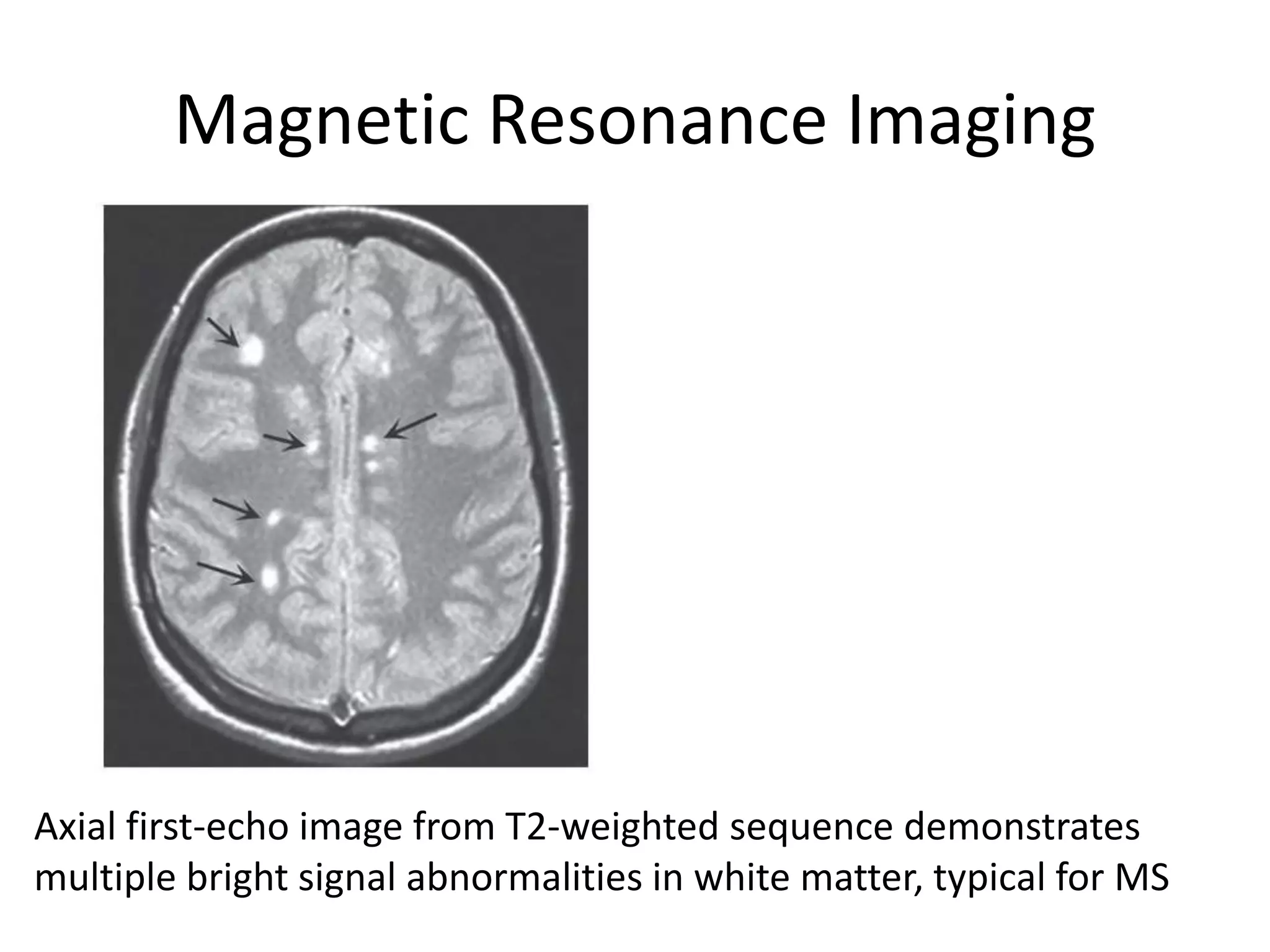 Magnetic Resonance Imaging
Axial first-echo image from T2-weighted sequence demonstrates
multiple bright signal abnormalities in white matter, typical for MS
 