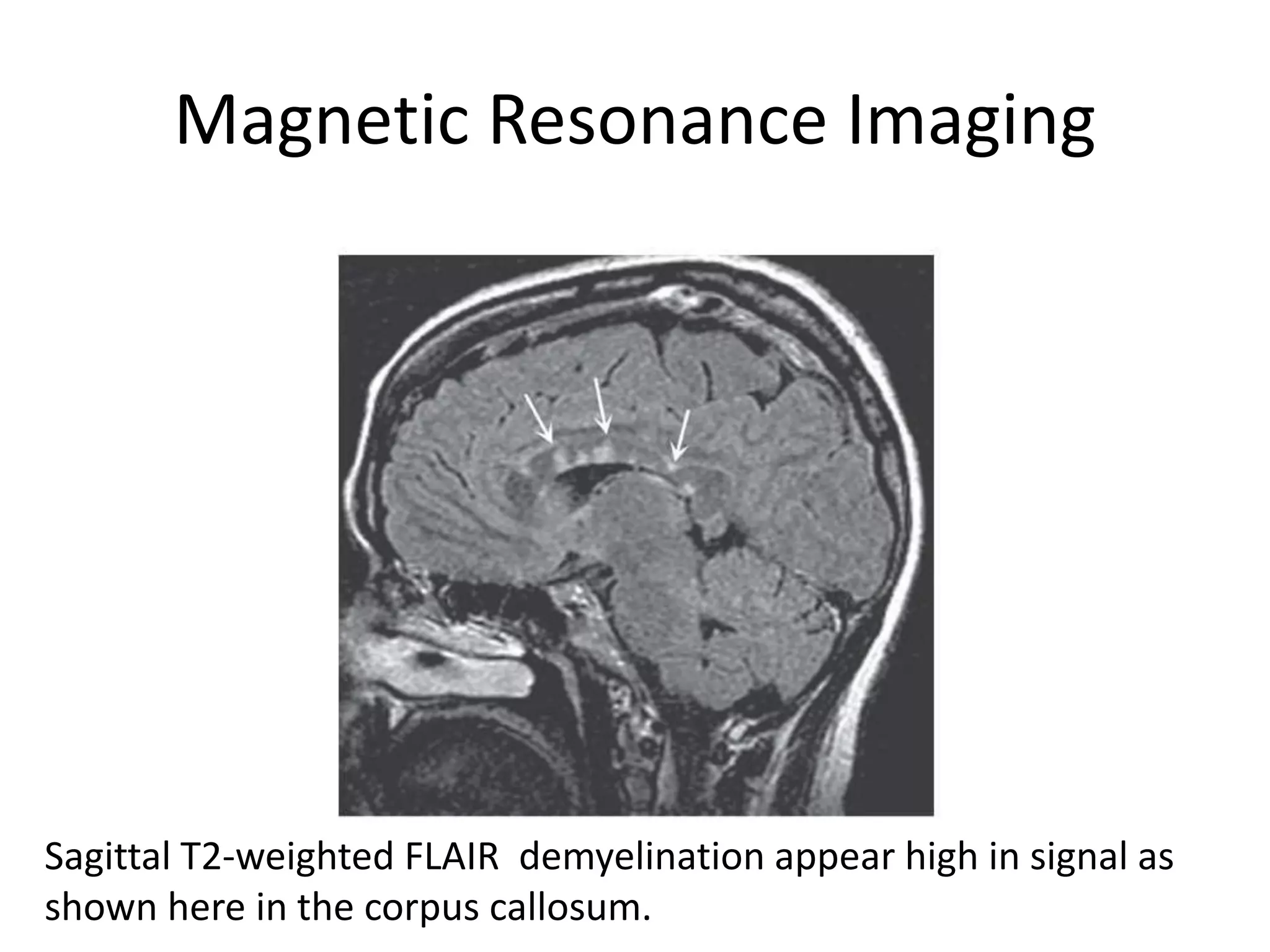 Magnetic Resonance Imaging
Sagittal T2-weighted FLAIR demyelination appear high in signal as
shown here in the corpus callosum.
 
