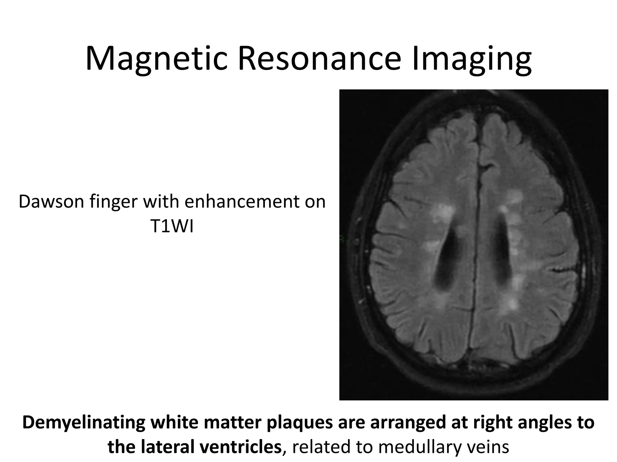 Magnetic Resonance Imaging
Demyelinating white matter plaques are arranged at right angles to
the lateral ventricles, related to medullary veins
Dawson finger with enhancement on
T1WI
 
