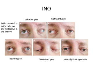 INO
Normal primary position
Leftward gaze Rightward gaze
Upward gaze Downward gaze
Adduction deficit
in the right eye
and nystagmus in
the left eye
 