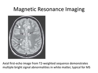 Magnetic Resonance Imaging
Axial first-echo image from T2-weighted sequence demonstrates
multiple bright signal abnormalities in white matter, typical for MS
 