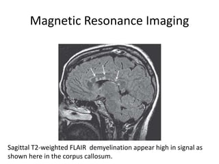Magnetic Resonance Imaging
Sagittal T2-weighted FLAIR demyelination appear high in signal as
shown here in the corpus callosum.
 