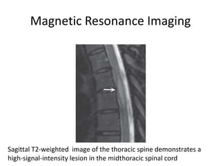 Magnetic Resonance Imaging
Sagittal T2-weighted image of the thoracic spine demonstrates a
high-signal-intensity lesion in the midthoracic spinal cord
 