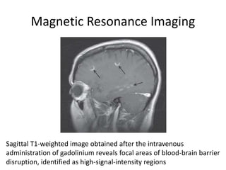 Magnetic Resonance Imaging
Sagittal T1-weighted image obtained after the intravenous
administration of gadolinium reveals focal areas of blood-brain barrier
disruption, identified as high-signal-intensity regions
 