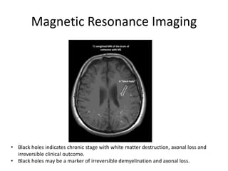 Magnetic Resonance Imaging
• Black holes indicates chronic stage with white matter destruction, axonal loss and
irreversible clinical outcome.
• Black holes may be a marker of irreversible demyelination and axonal loss.
 