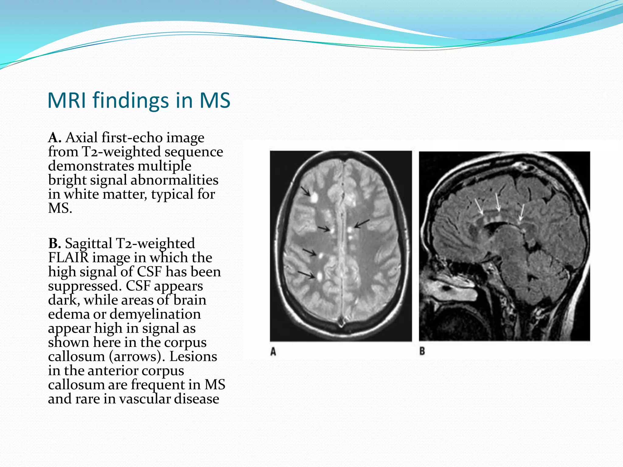 MRI findings in MS
A. Axial first-echo image
from T2-weighted sequence
demonstrates multiple
bright signal abnormalities
in white matter, typical for
MS.
B. Sagittal T2-weighted
FLAIR image in which the
high signal of CSF has been
suppressed. CSF appears
dark, while areas of brain
edema or demyelination
appear high in signal as
shown here in the corpus
callosum (arrows). Lesions
in the anterior corpus
callosum are frequent in MS
and rare in vascular disease
 