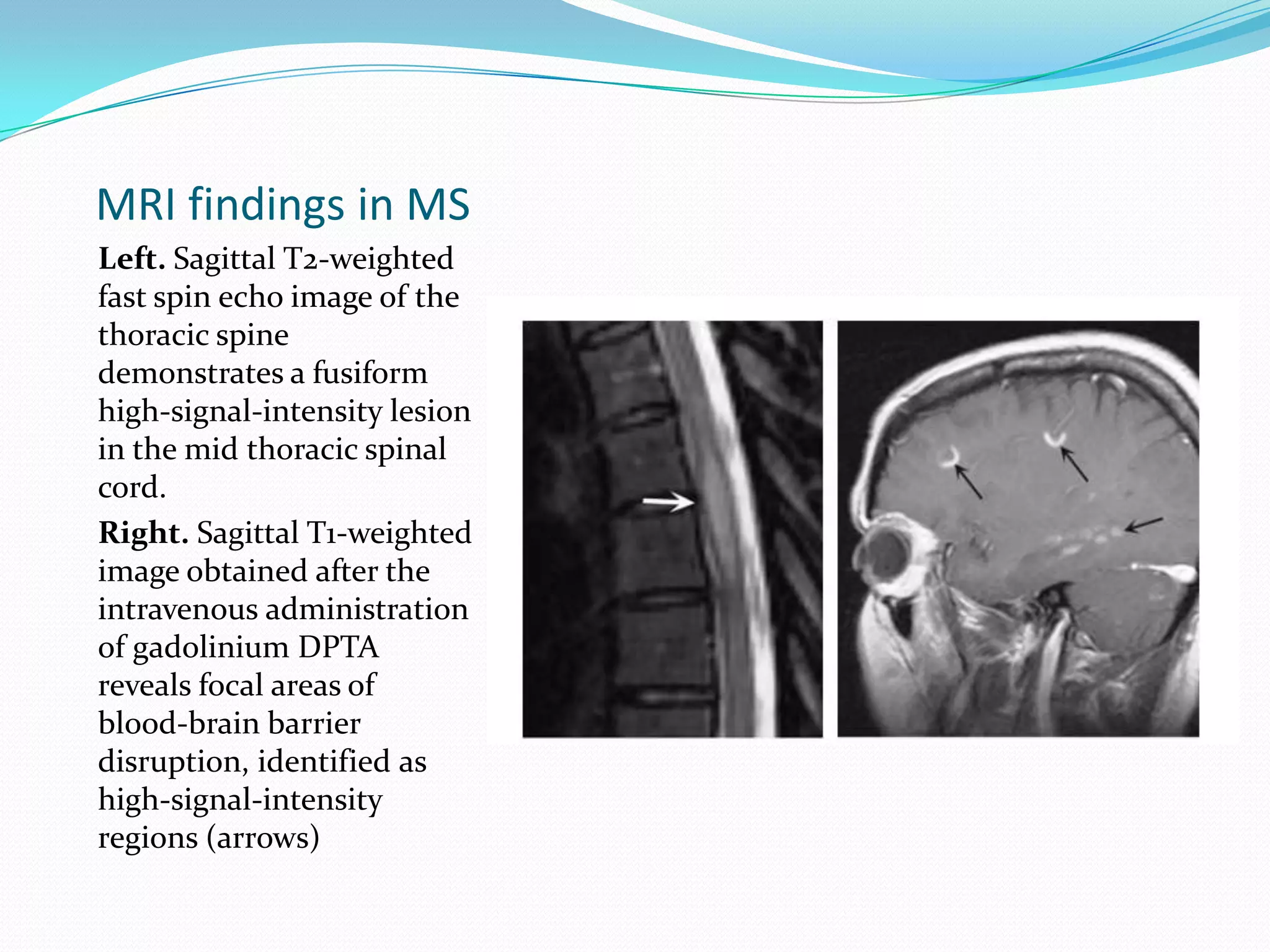 MRI findings in MS
Left. Sagittal T2-weighted
fast spin echo image of the
thoracic spine
demonstrates a fusiform
high-signal-intensity lesion
in the mid thoracic spinal
cord.
Right. Sagittal T1-weighted
image obtained after the
intravenous administration
of gadolinium DPTA
reveals focal areas of
blood-brain barrier
disruption, identified as
high-signal-intensity
regions (arrows)
 