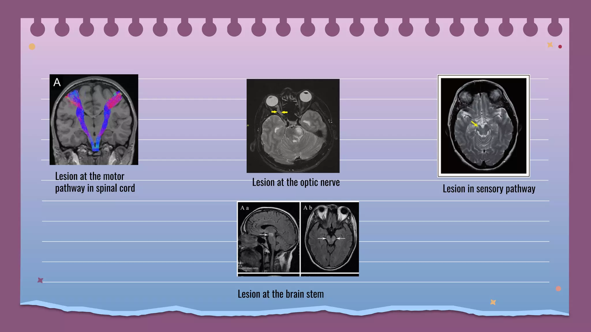 Lesion in sensory pathway
Lesion at the motor
pathway in spinal cord
Lesion at the optic nerve
Lesion at the brain stem
 