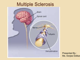 Presented By :
Ms. Dorjee Dolkar
Multiple Sclerosis
 