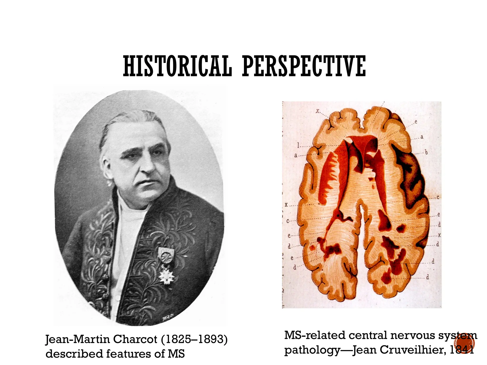HISTORICAL PERSPECTIVE
Jean-Martin Charcot (1825–1893)
described features of MS
MS-related central nervous system
pathology—Jean Cruveilhier, 1841
 