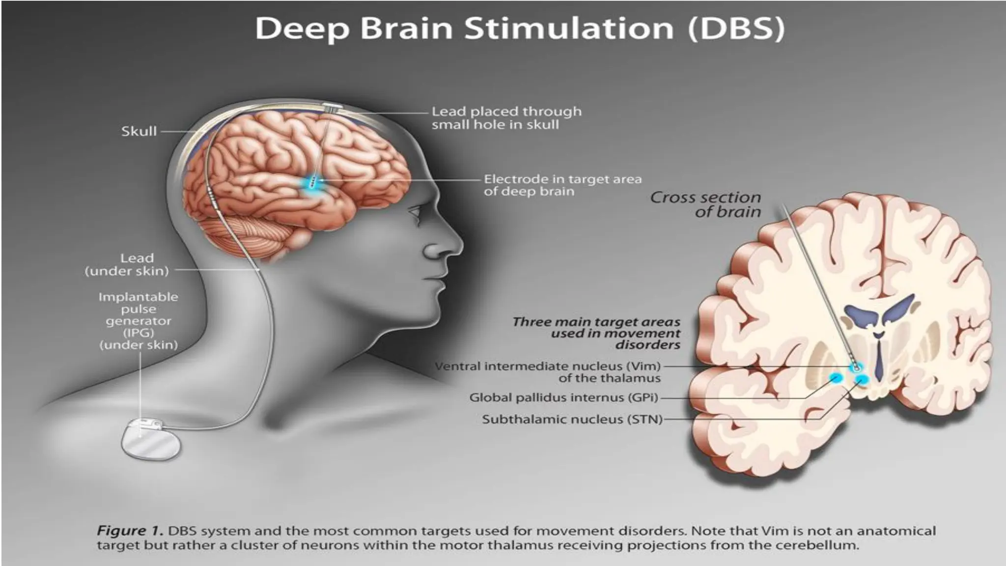 DEEP BRAIN
STIMULATION
 