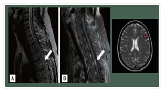 Multiple Sclerosis (Group 2).pptx . | PPTX