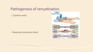 Pathogenesis of remyelination
• Cytokine wash
• Resolved conduction block
 