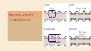 Paroxysmal symptoms
• Ephaptic transmission
 