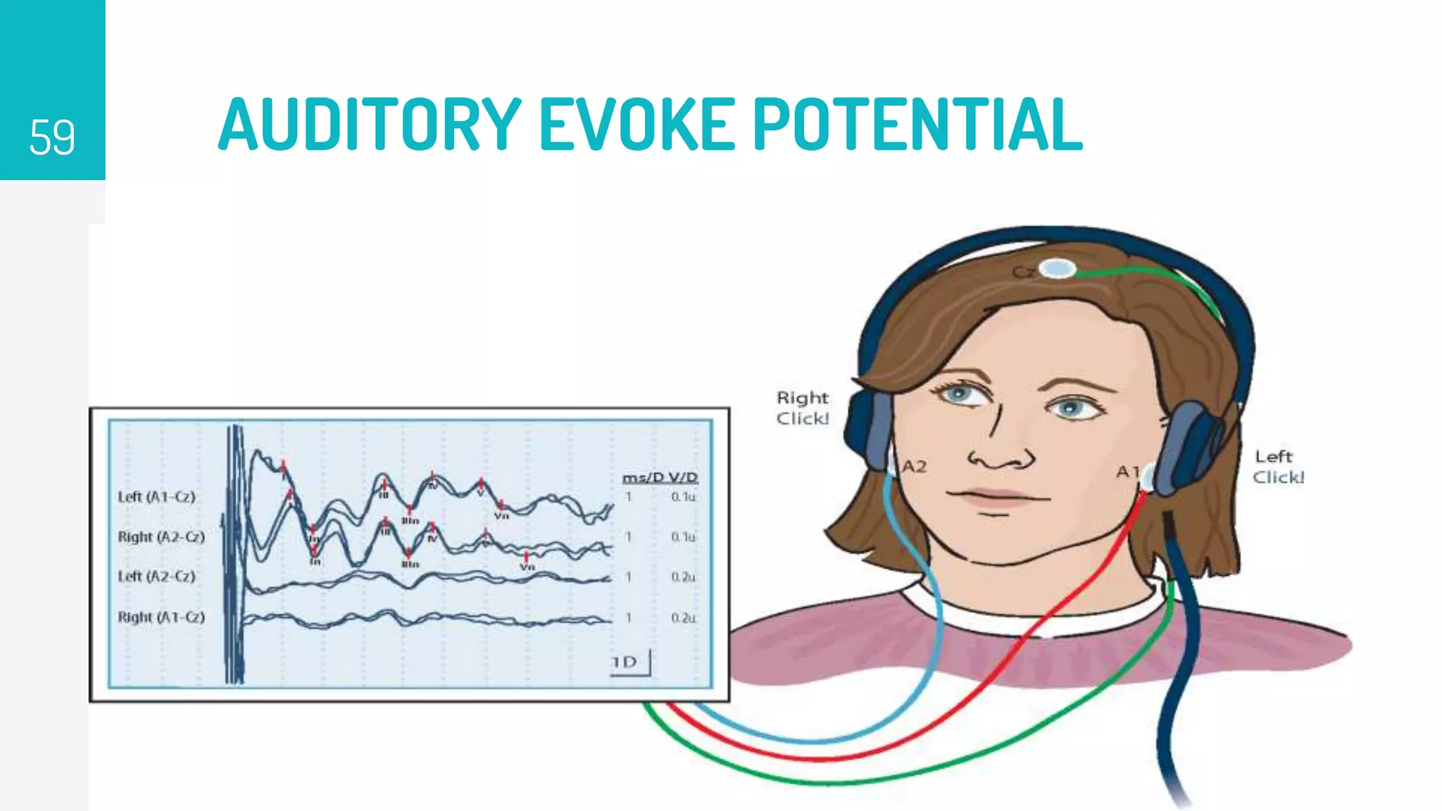 AUDITORY EVOKE POTENTIAL
59
 