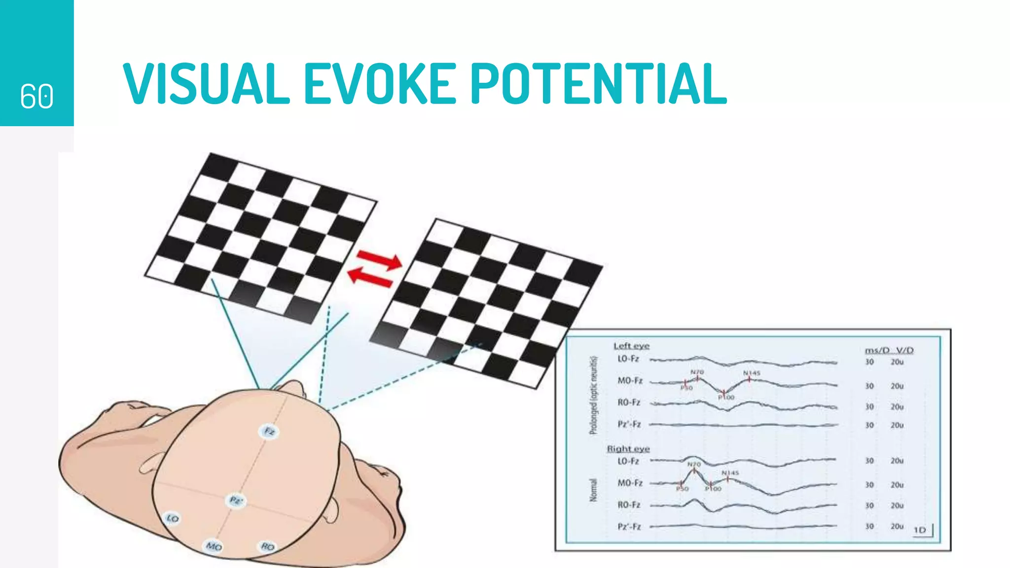 VISUAL EVOKE POTENTIAL
60
 