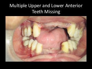 Multiple Upper and Lower Anterior Teeth Missing  