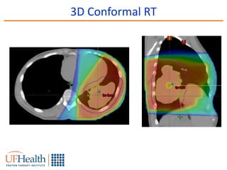 Radiation Therapy in the Management of Lung Cancer | PPTX