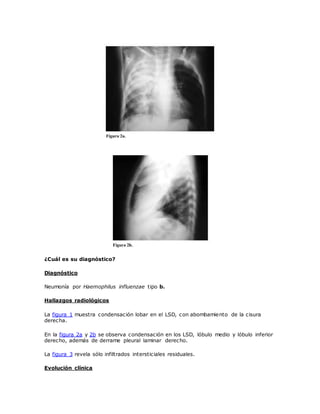 ¿Cuál es su diagnóstico?
Diagnóstico
Neumonía por Haemophilus influenzae tipo b.
Hallazgos radiológicos
La figura 1 muestra condensación lobar en el LSD, con abombamiento de la cisura
derecha.
En la figura 2a y 2b se observa condensación en los LSD, lóbulo medio y lóbulo inferior
derecho, además de derrame pleural laminar derecho.
La figura 3 revela sólo infiltrados intersticiales residuales.
Evolución clínica
 