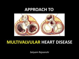 APPROACH TO
MULTIVALVULAR HEART DISEASE
Satyam Rajvanshi
 