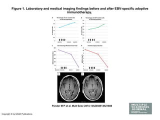 Figure 1. Laboratory and medical imaging findings before and after EBV-specific adoptive
immunotherapy.
Pender M P et al. Mult Scler 2014;1352458514521888
Copyright © by SAGE Publications
 