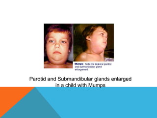 Mumps | PPTX
