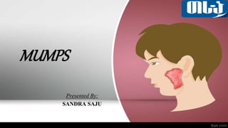 MUMPS
Presented By:
SANDRA SAJU
 