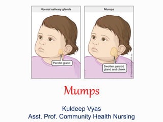 Mumps
Kuldeep Vyas
Asst. Prof. Community Health Nursing
 