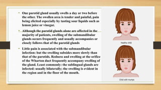 • One parotid gland usually swells a day or two before
the other. The swollen area is tender and painful, pain
being elicited especially by tasting sour liquids such as
lemon juice or vinegar.
• Although the parotid glands alone are affected in the
majority of patients, swelling of the submandibular
glands occurs frequently and usually accompanies or
closely follows that of the parotid glands
• Little pain is associated with the submandibular
infection: but the swelling subsides more slowly than
that of the parotids. Redness and swelling at the orifice
of the Wharton duct frequently accompany swelling of
the gland. Least commonly: the sublingual glands are
infected: usually bilaterally; the swelling is evident in
the region and in the floor of the mouth.
 