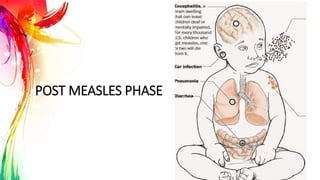 POST MEASLES PHASE
 