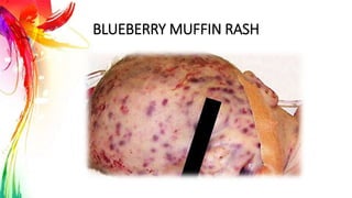 BLUEBERRY MUFFIN RASH
 