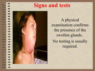 Signs and tests A physical examination confirms the presence of the swollen glands.  No testing is usually required. 