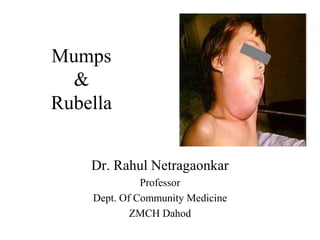 Mumps
&
Rubella
Dr. Rahul Netragaonkar
Professor
Dept. Of Community Medicine
ZMCH Dahod
 