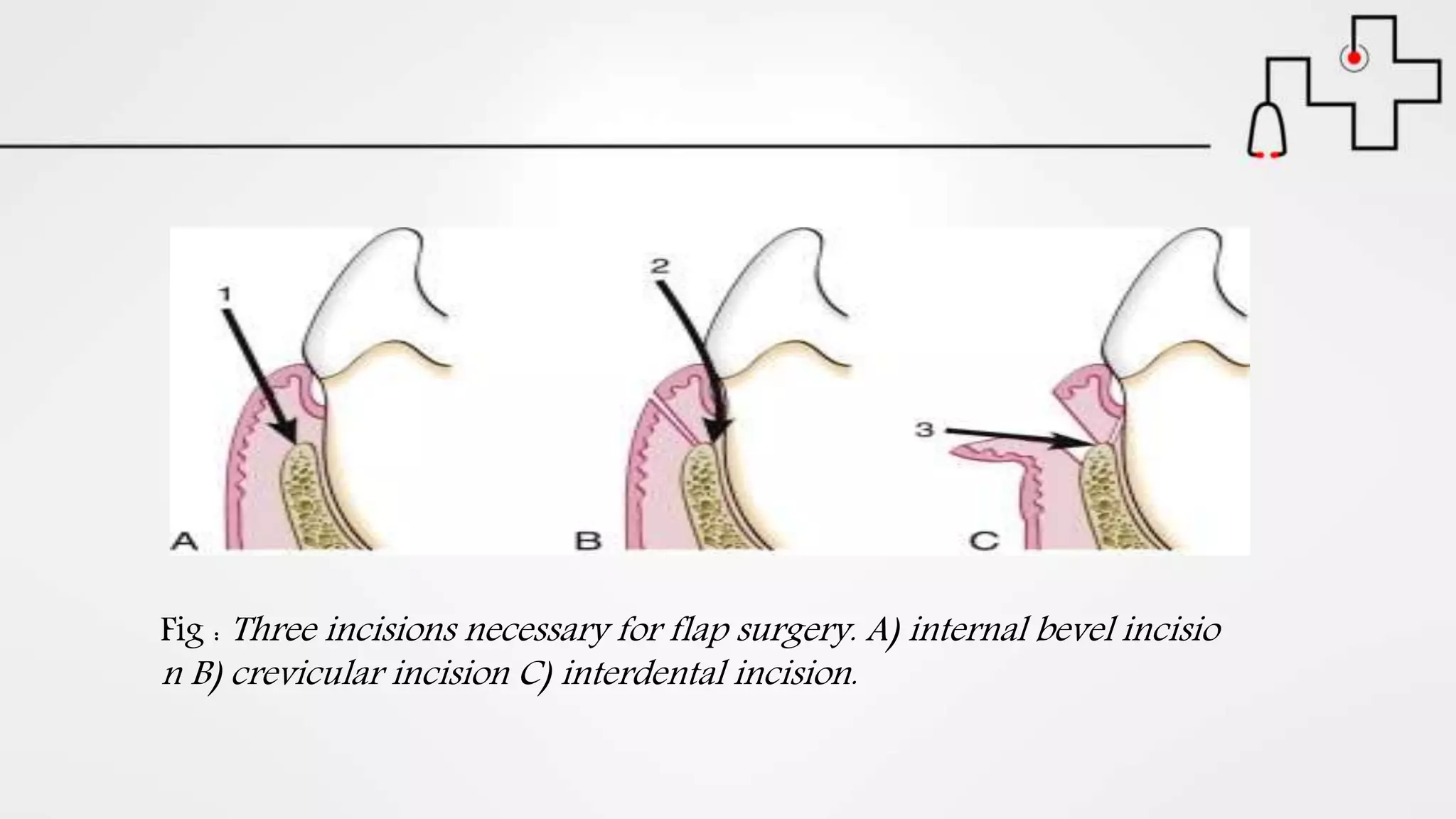 Fig : Three incisions necessary for flap surgery. A) internal bevel incisio
n B) crevicular incision C) interdental incision.
 