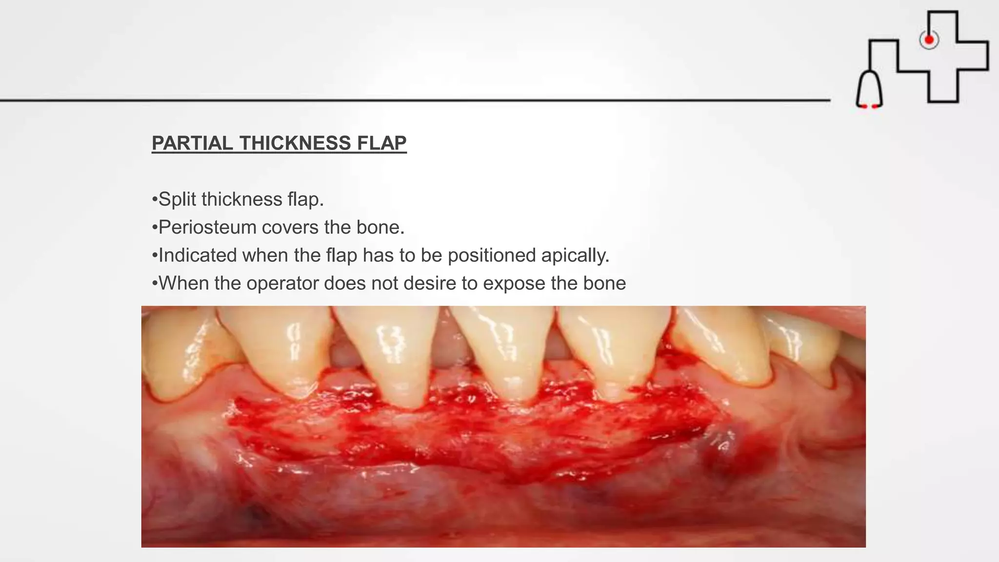 PARTIAL THICKNESS FLAP
•Split thickness flap.
•Periosteum covers the bone.
•Indicated when the flap has to be positioned apically.
•When the operator does not desire to expose the bone
 