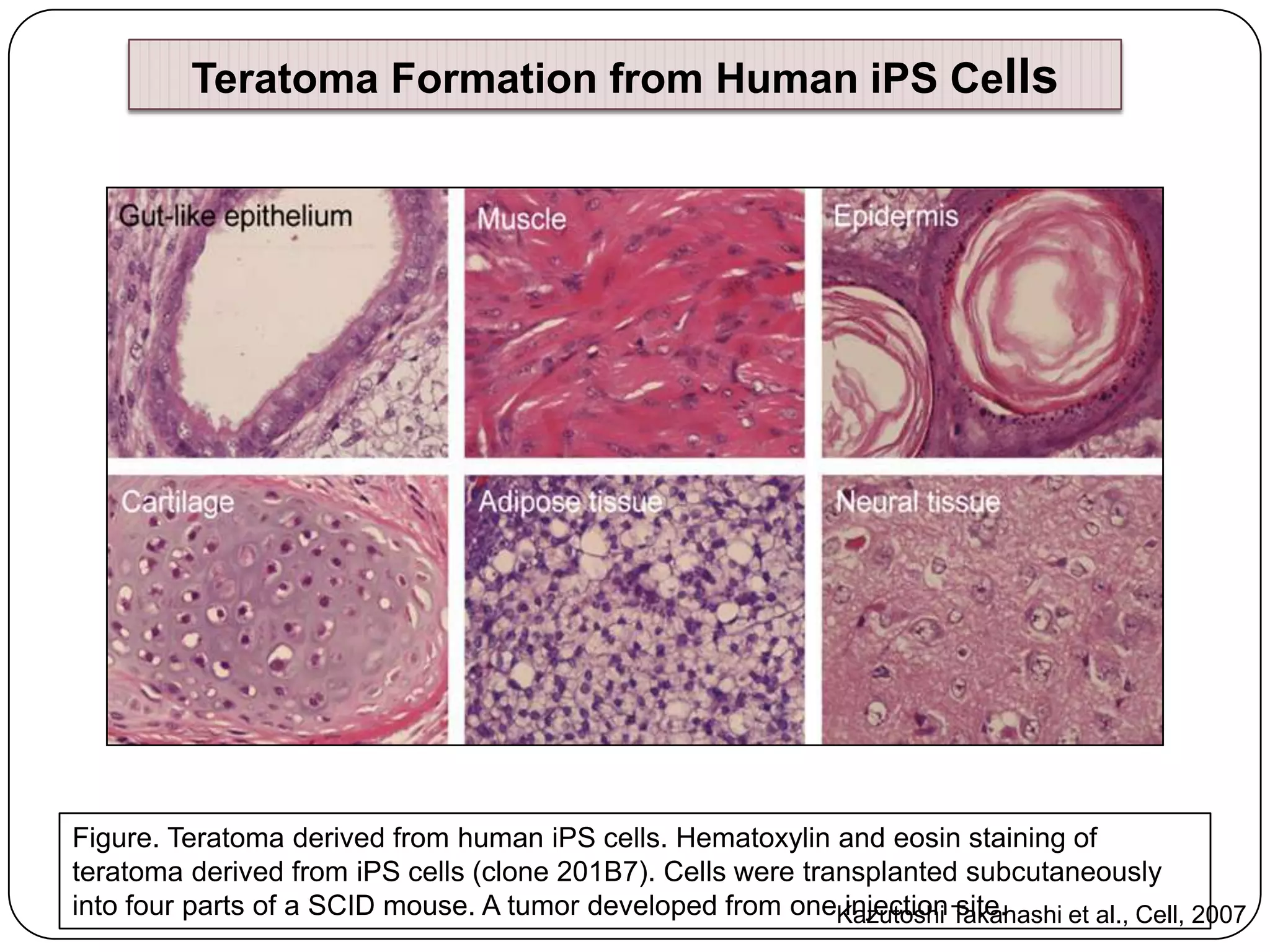 Teratoma Formation from Human iPS Cells

Figure. Teratoma derived from human iPS cells. Hematoxylin and eosin staining of
teratoma derived from iPS cells (clone 201B7). Cells were transplanted subcutaneously
into four parts of a SCID mouse. A tumor developed from oneKazutoshi Takahashi et al., Cell, 2007
injection site.

 