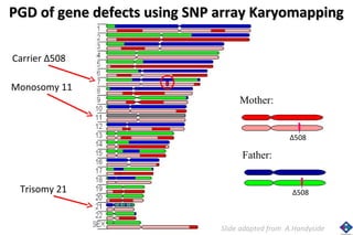 PGD of ggeennee ddeeffeeccttss uussiinngg SSNNPP aarrrraayy KKaarryyoommaappppiinngg 
Δ508 
Father: 
Δ508 
Mother: 
Slide adapted from A.Handyside 
Carrier Δ508 
Monosomy 11 
Trisomy 21 
 