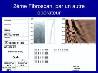 2ème Fibroscan, par un autre opérateur 