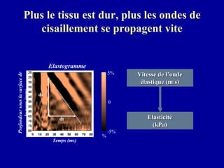 Plus le tissu est dur, plus les ondes de cisaillement se propagent vite % -5% 0  5%  Elastogramme dt Vitesse de l’onde élastique (m/s) Elasticité (kPa) Profondeur sous la surface de la peau (mm) Temps (ms) dz 