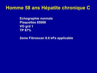 Echographie normale Plaquettes 85000 VO grd 1 TP 87% 2eme Fibroscan 8.6 kPa applicable Homme 58 ans Hépatite chronique C 