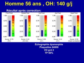 Echographie dysmorphie Plaquettes 84000 VO grd 2 TP 66% Homme 56 ans , OH: 140 g/j   Résultat après correction:   