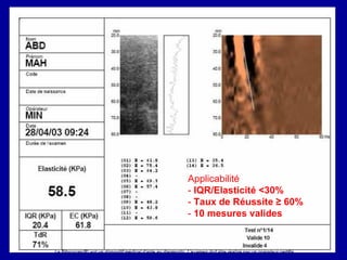 Applicabilité  -  IQR/Elasticité <30%   -  Taux de Réussite ≥ 60%   -  10 mesures valides 