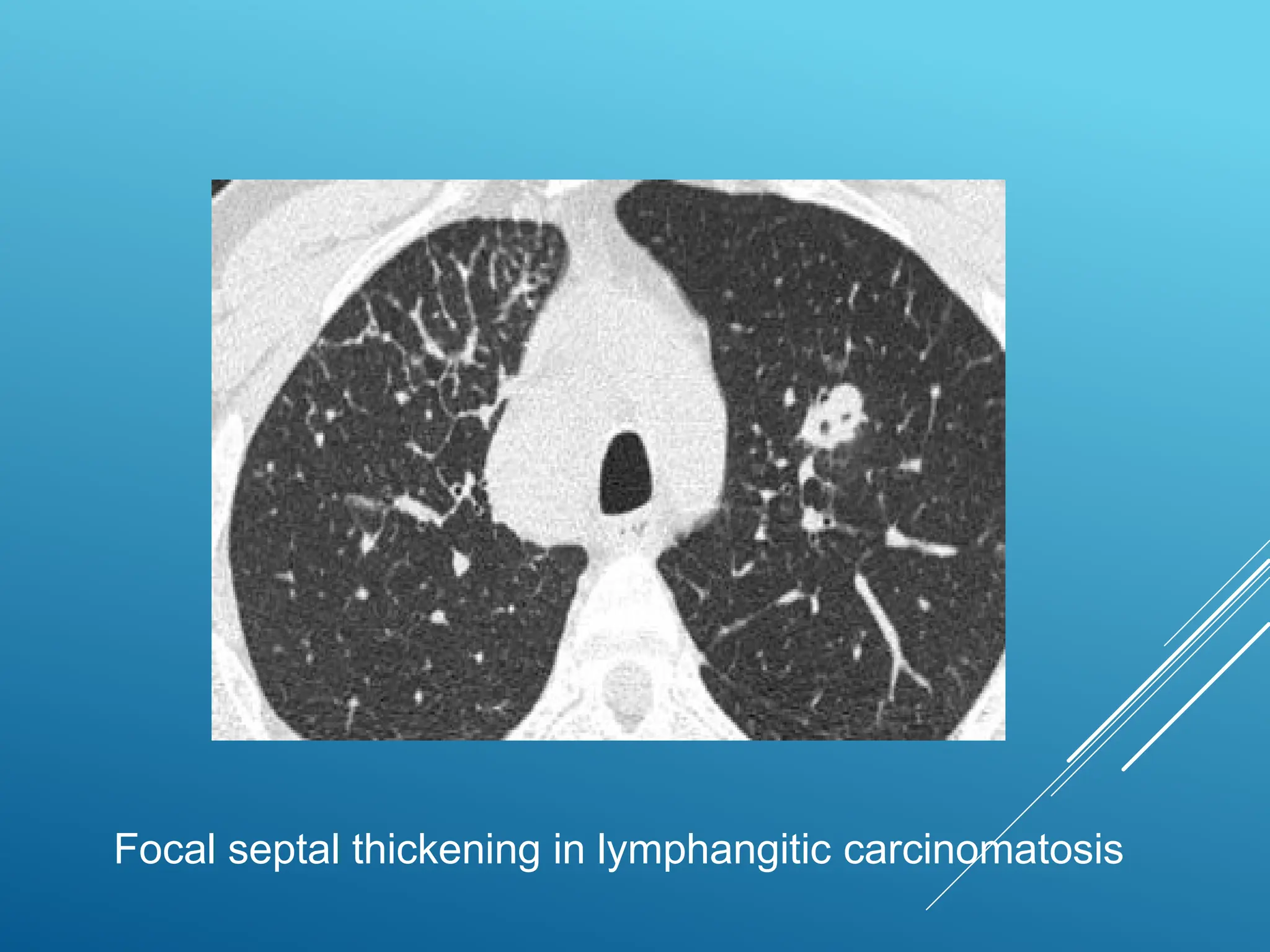 Focal septal thickening in lymphangitic carcinomatosis
 