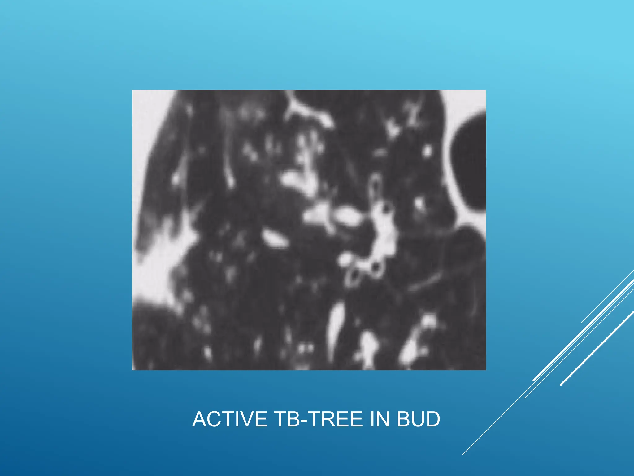 ACTIVE TB-TREE IN BUD
 