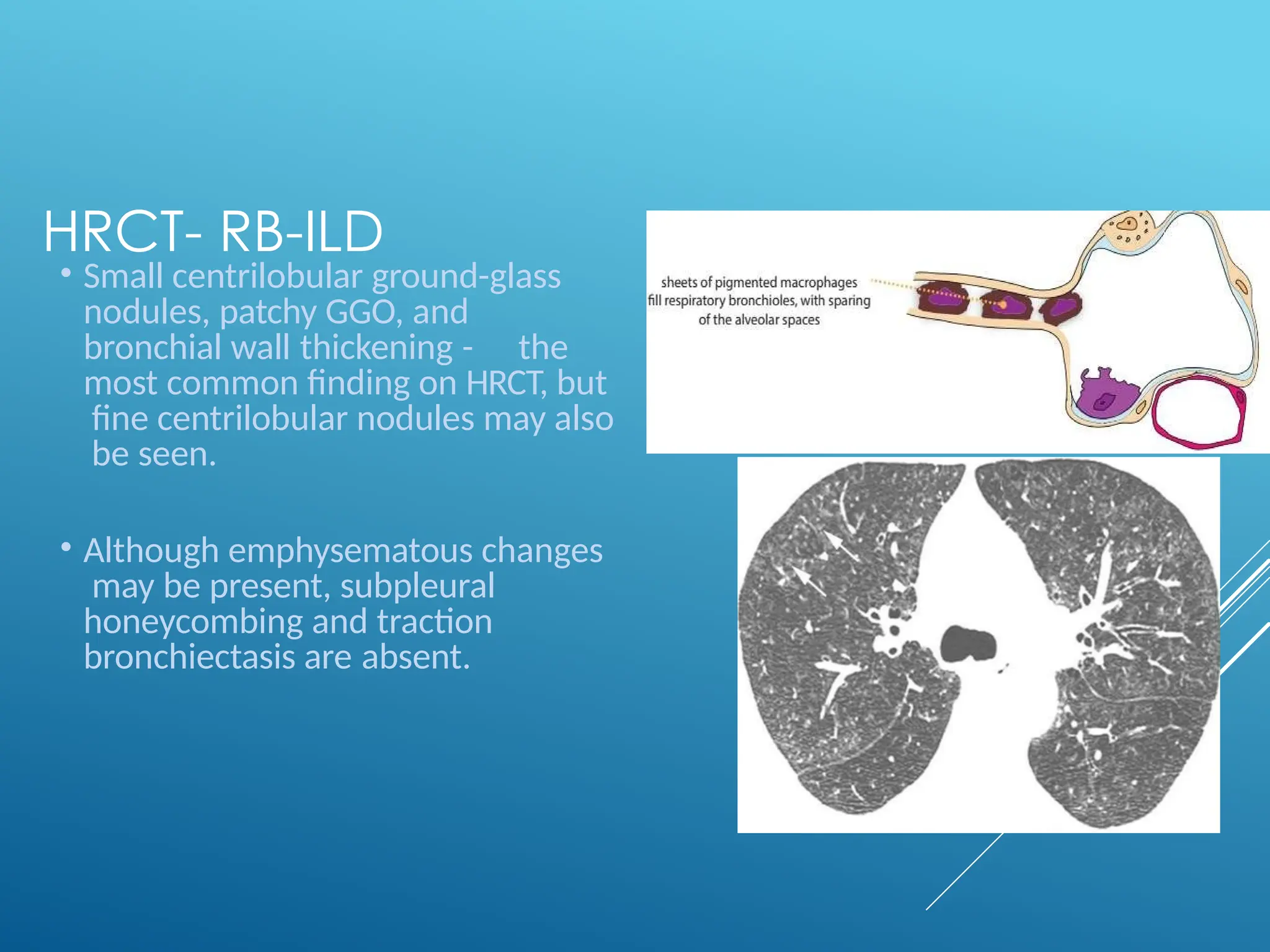 HRCT- RB-ILD
• Small centrilobular ground-glass
nodules, patchy GGO, and
bronchial wall thickening - the
most common finding on HRCT, but
fine centrilobular nodules may also
be seen.
• Although emphysematous changes
may be present, subpleural
honeycombing and traction
bronchiectasis are absent.
 
