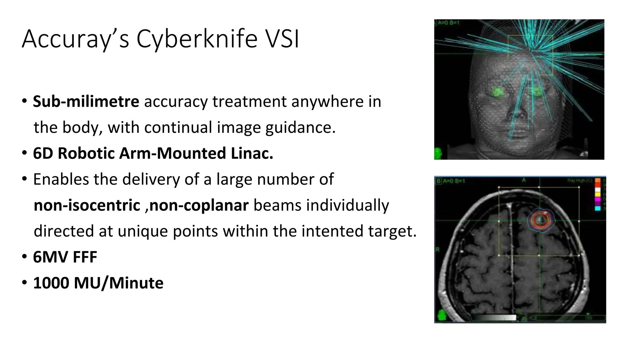 Accuray’s Cyberknife VSI
• Sub-milimetre accuracy treatment anywhere in
the body, with continual image guidance.
• 6D Robotic Arm-Mounted Linac.
• Enables the delivery of a large number of
non-isocentric ,non-coplanar beams individually
directed at unique points within the intented target.
• 6MV FFF
• 1000 MU/Minute
 