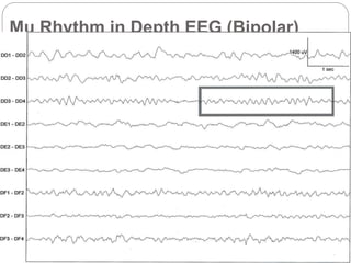 Mu Rythmn Eeg Examples Mu rhythm | PPTX