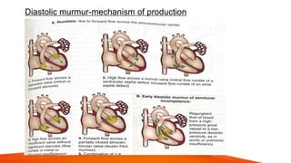 Diastolic murmur-mechanism of production
 