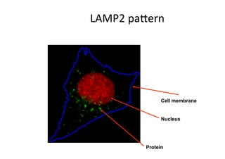 LAMP2 paVern 




               Cell membrane


               Nucleus




         Protein
 